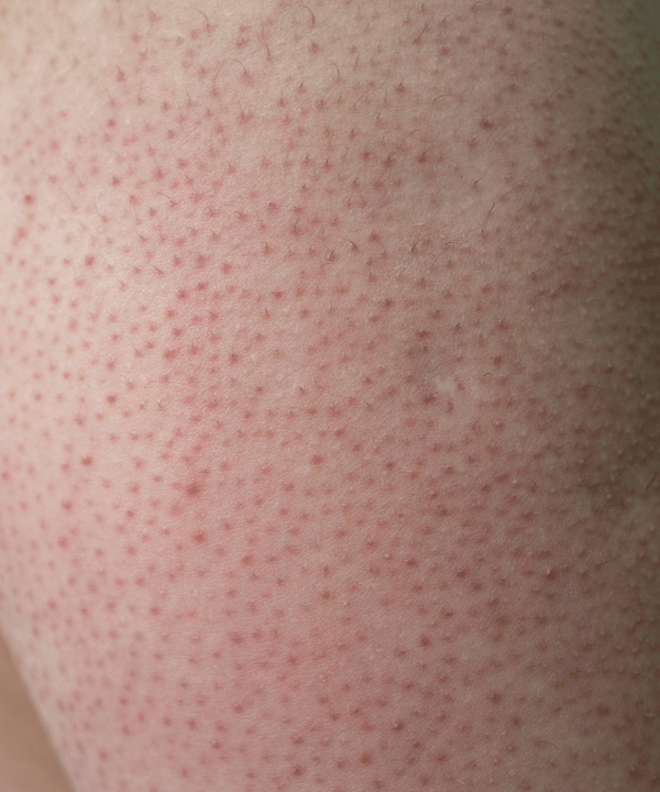Keratosis Pilaris (KP) A Natural Approach to Smoother Skin Edible